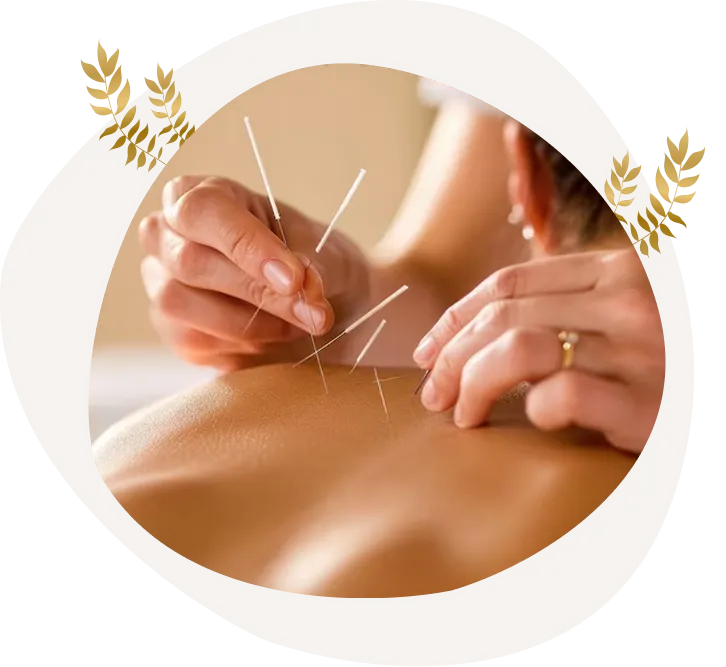 Benefits of Dry Needling Therapy in Wodonga