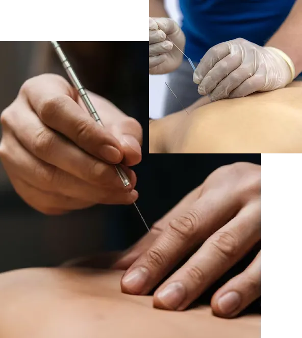 Why Our Dry Needling Treatment Stands Out
